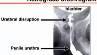 Catherisation for BDSM Play